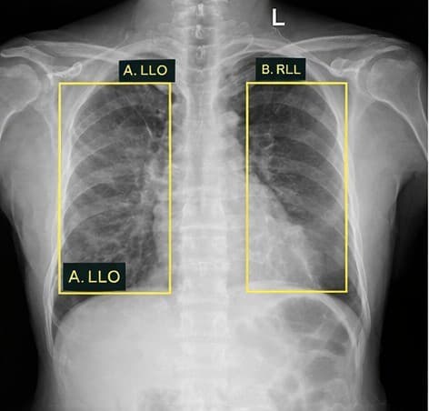 Chest X-ray